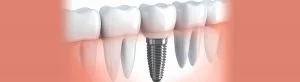 Dental implants Leicester