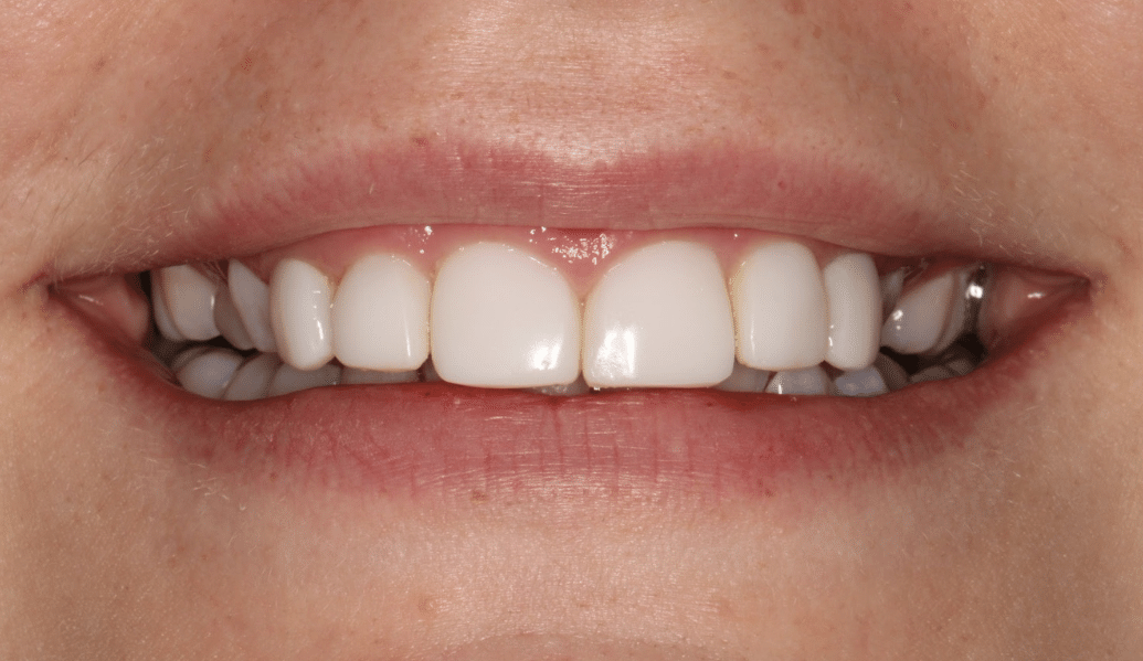 After - Fleckney Dental & Cosmetic Clinic