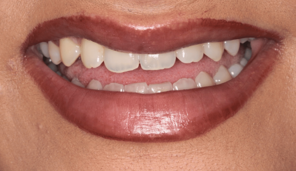 Before - Fleckney Dental & Cosmetic Clinic