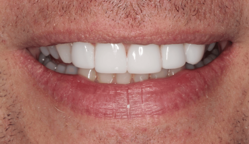 After - Fleckney Dental & Cosmetic Clinic