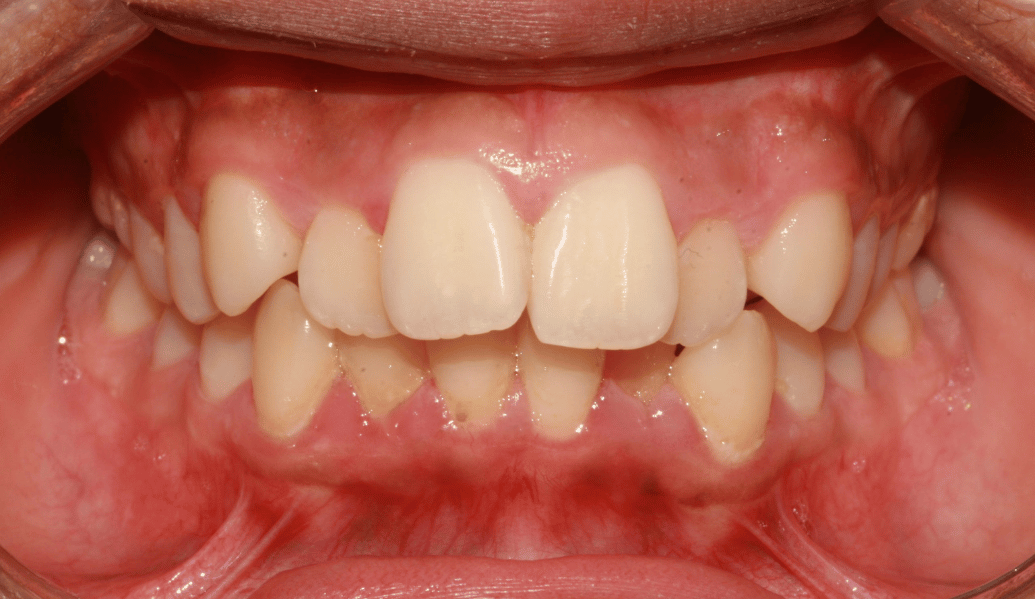Before - Fleckney Dental & Cosmetic Clinic