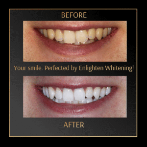 Professional Teeth Whitening Leicester 
