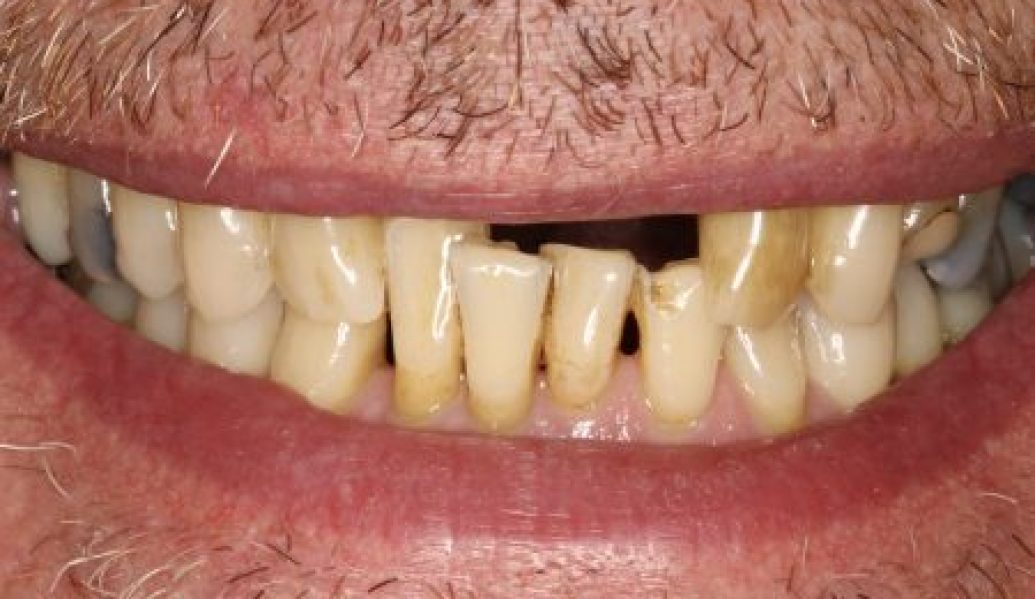 Before Dental Implants