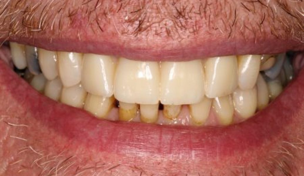 After Dental Implants